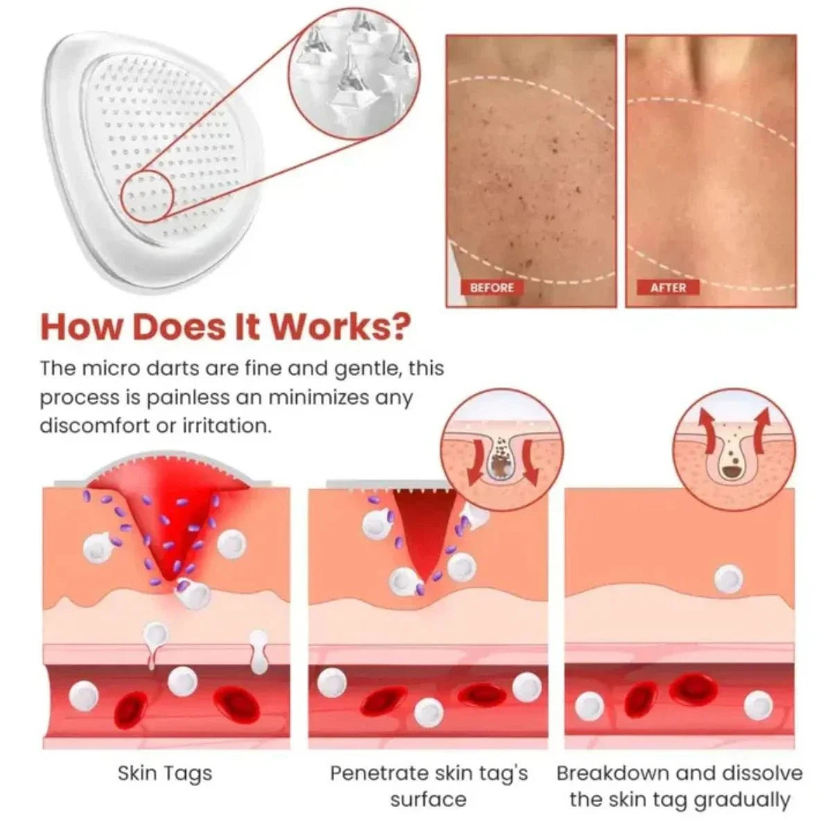 DermaSmooth Skin Tag, Mole Remover Patch | Nano-Microneedle | 72 Patches